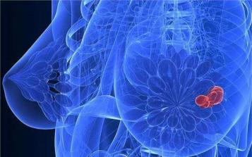 按摩、拔火罐治乳房結(jié)節(jié)?寧波女子一年后確診乳腺癌晚期！