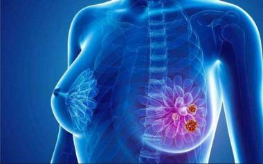 緊張備考錯過早診機會，18歲女生高考前查出乳腺癌！