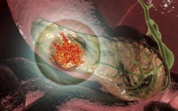 七旬奶奶突發(fā)腹痛一查竟是胰腺癌！胰腺癌早期難察覺(jué)