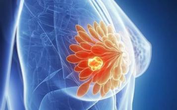 女性乳腺癌成為全球確診數(shù)量最多的癌癥！誰是高危人群？