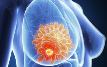 知道嗎？很多乳腺癌是吃出來的！這六類女性尤其小心