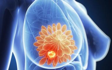 知道嗎？很多乳腺癌是吃出來的！這六類女性尤其小心